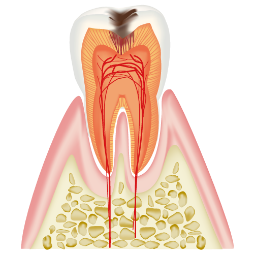 虫歯の進行(C2)
