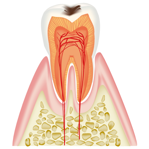 虫歯の進行(C1)