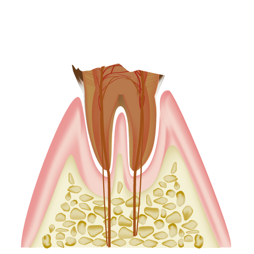 虫歯の進行(C4)