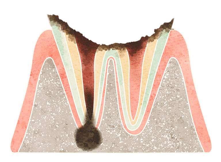 根管治療とは？