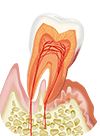 歯周病治療