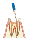 根管治療