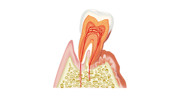 歯周病治療