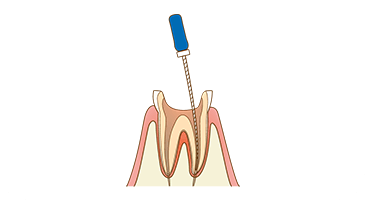 根管治療
