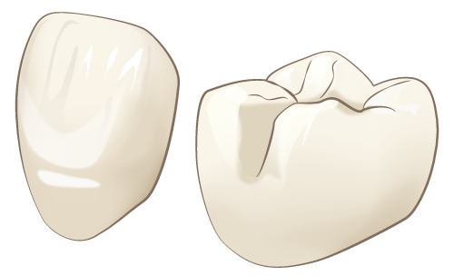 クラウン（被せ物）・インレー（詰め物）