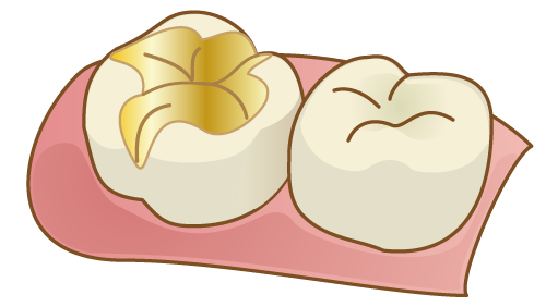 クラウン（被せ物）・インレー（詰め物）