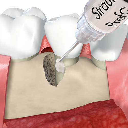 再生療法「エムドゲイン」とは