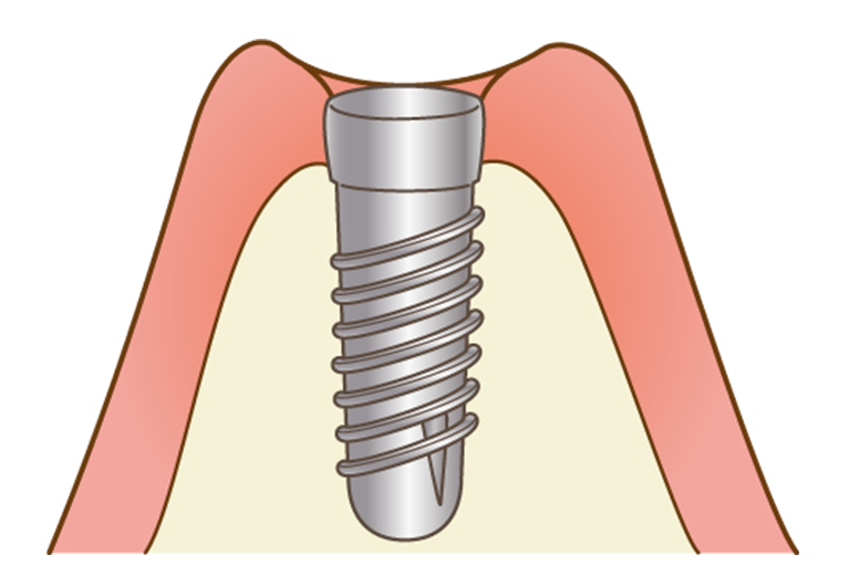 STEP04. インプラント埋入（一次手術）