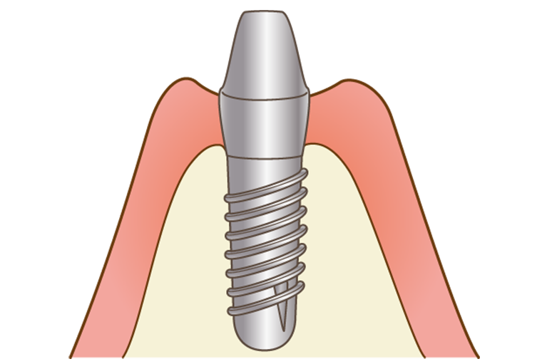 STEP06. アバットメント装着（二次手術）