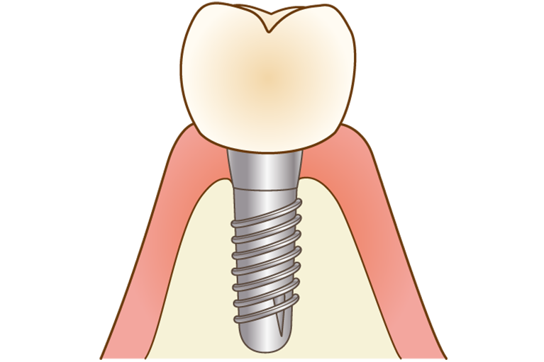 STEP07. 人工歯装着（インプラント完成）