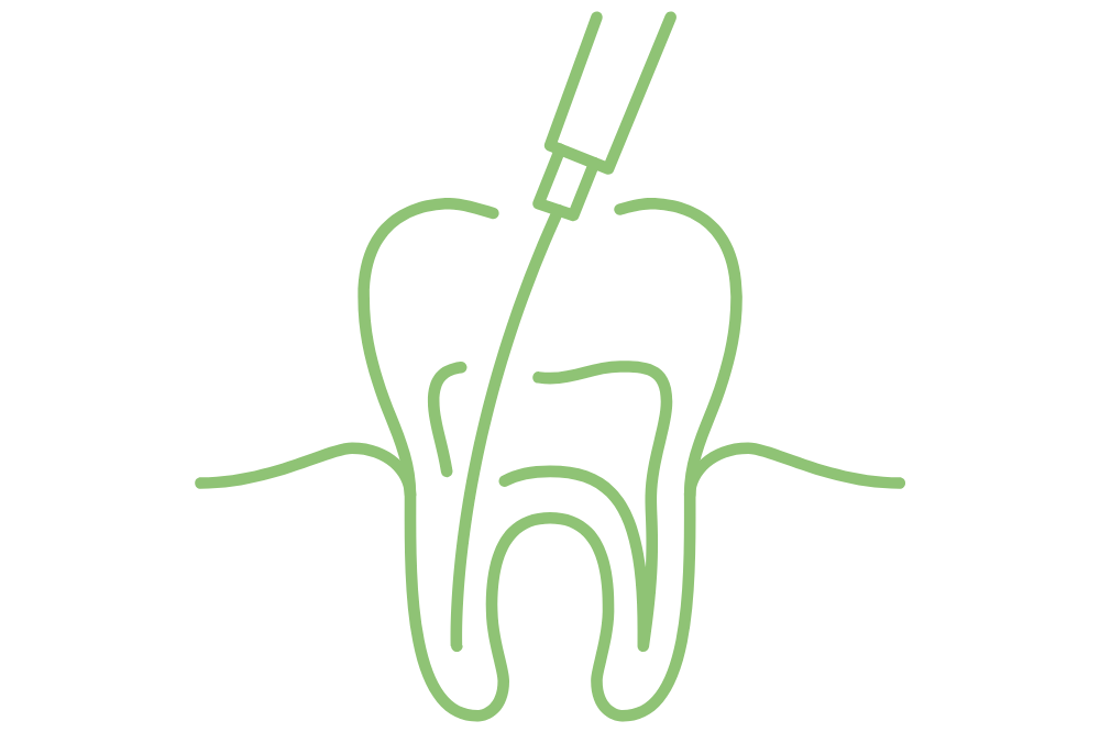 根管治療ってなに?