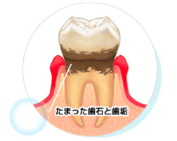 歯周病のお話〜なぜ歯石を取らないといけないのか！？