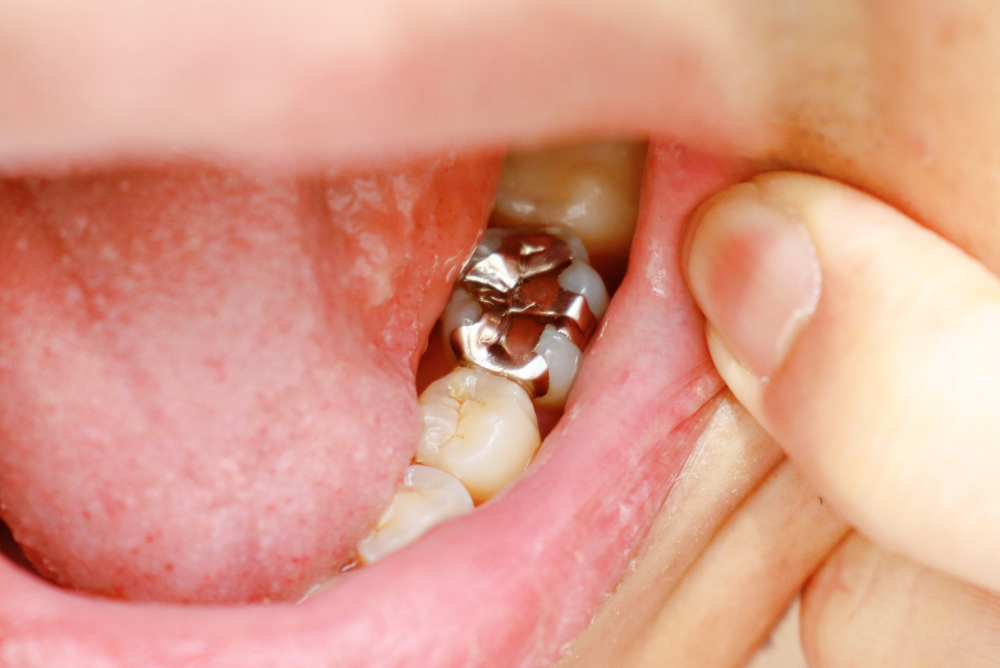 銀歯を白くしたい