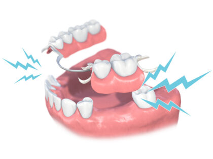 奥歯のインプラント治療について