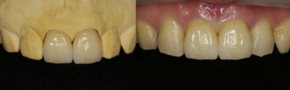 当院の審美歯科について